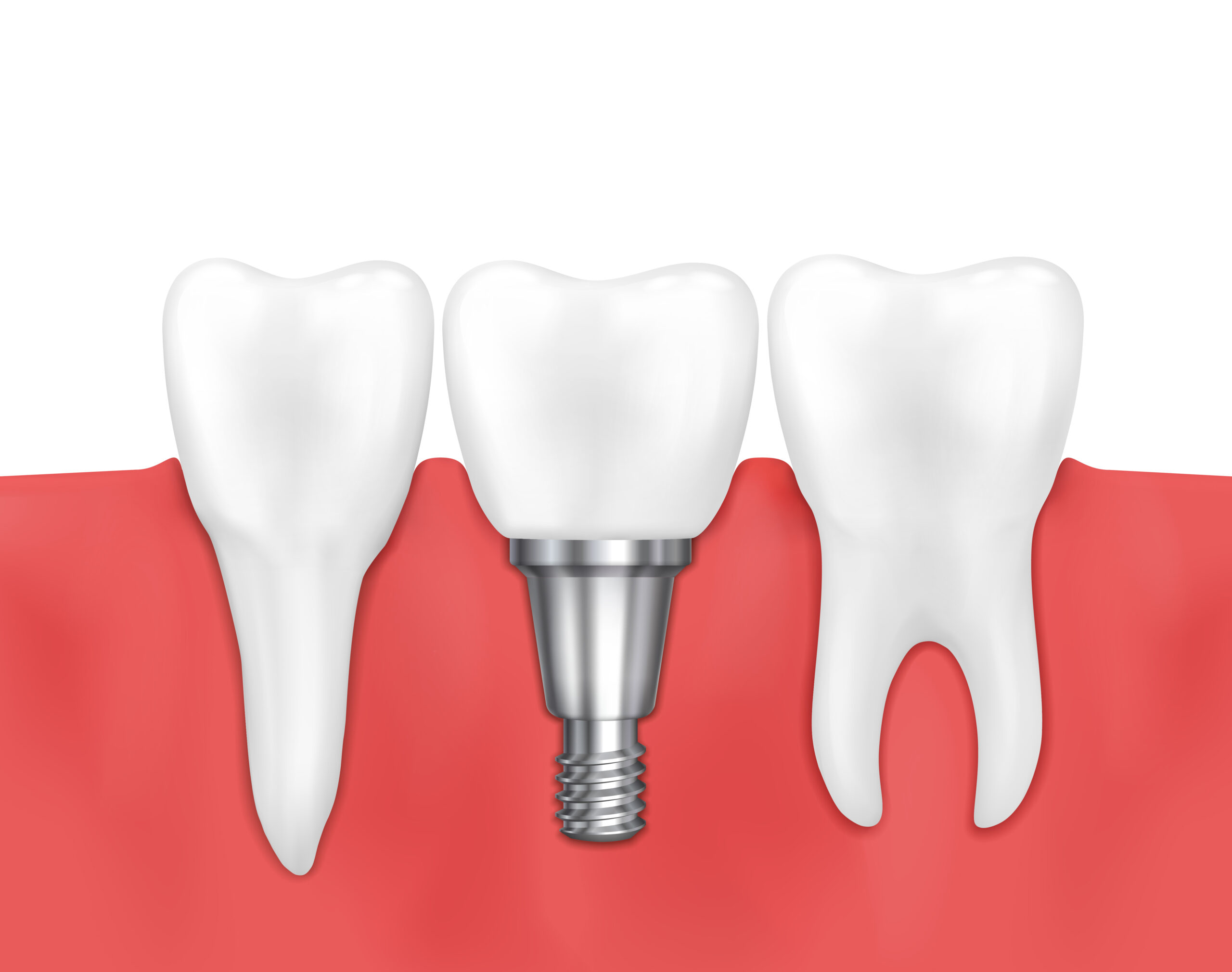Prix implants dentaires