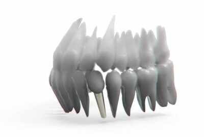 Tarifs implants dentaires