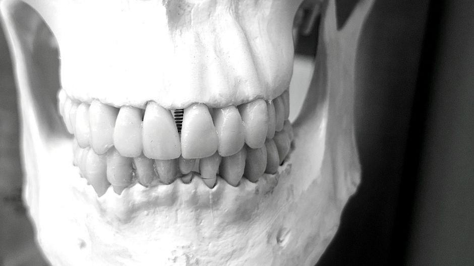 Greffe osseuse et implants : guide pour parents et enfants